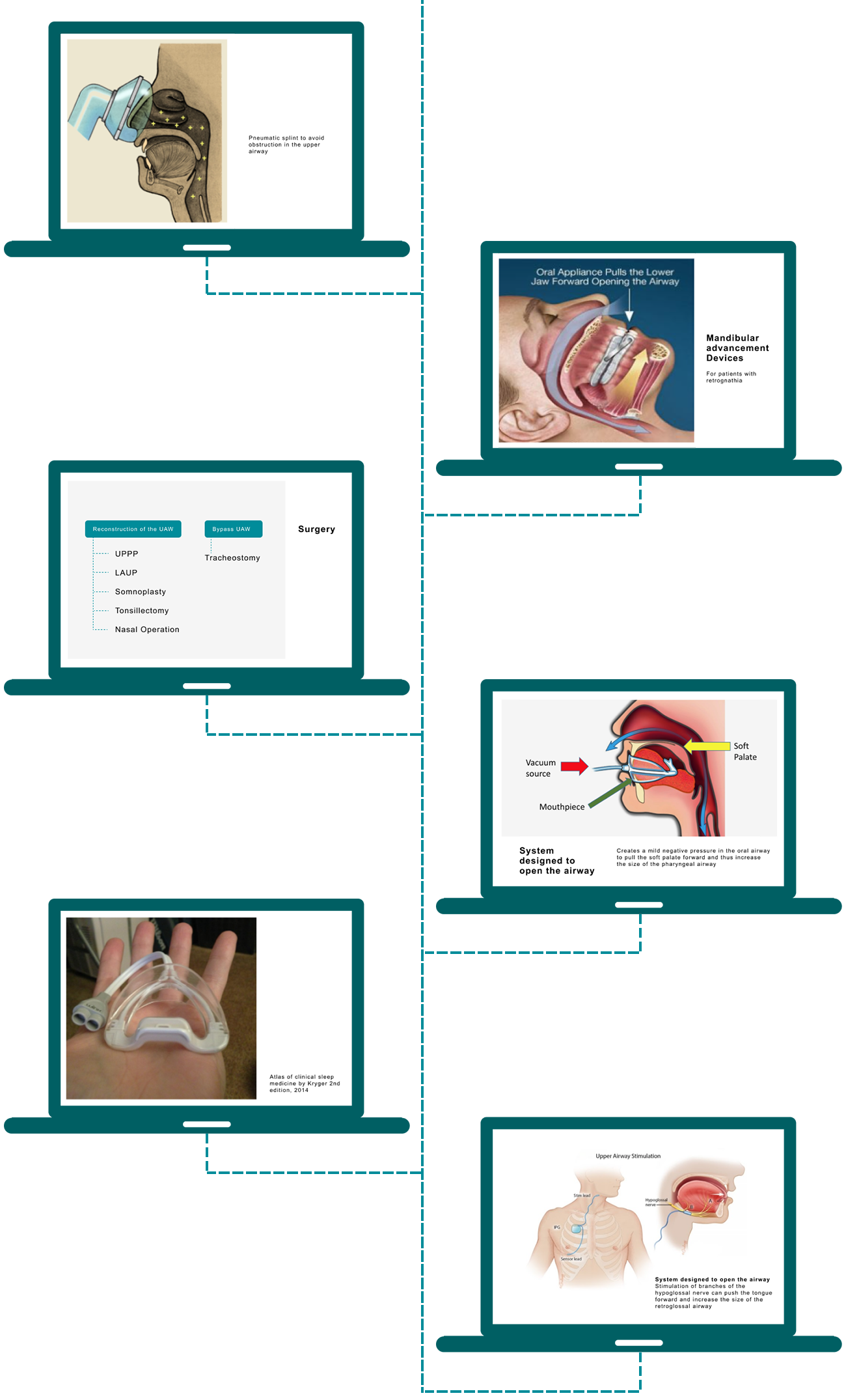 After diagnosing sleep apnea in a patient, the proper device for treating sleep apnea must be selected